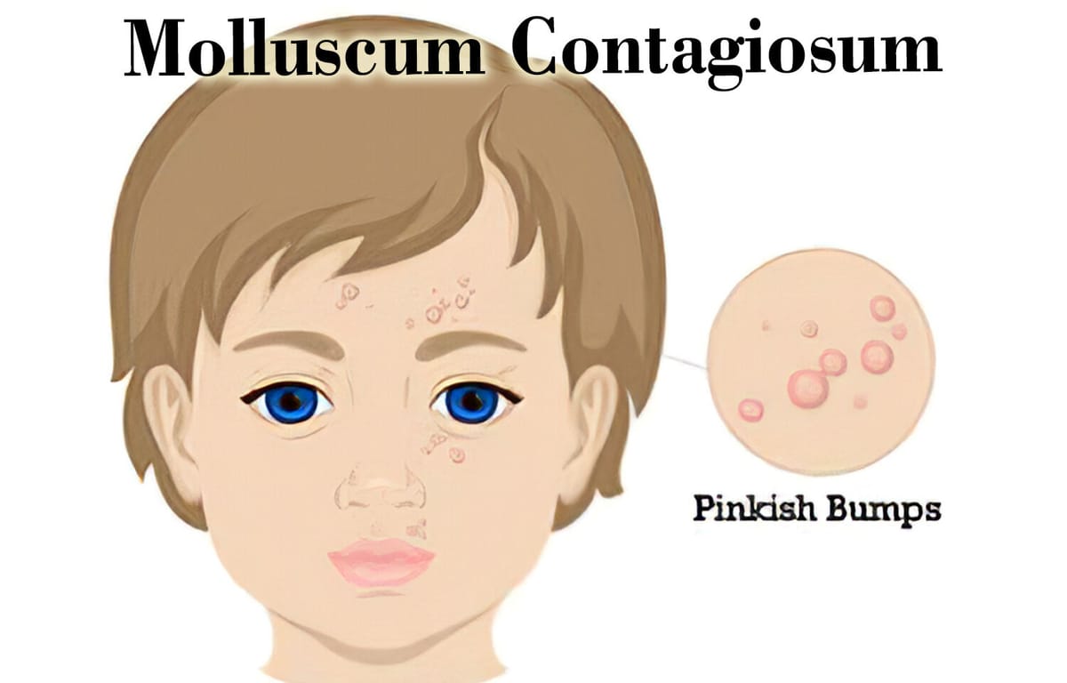 U mềm lây (Molluscom Contagiosum)