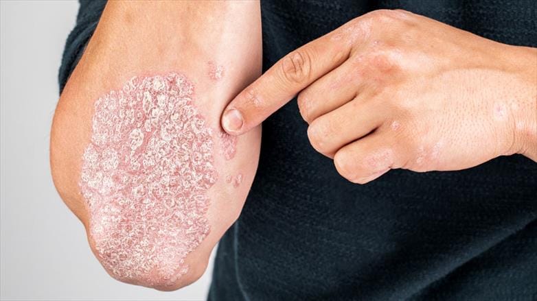 Vảy nến (Psoriasis): Xét nghiệm, chẩn đoán và điều trị