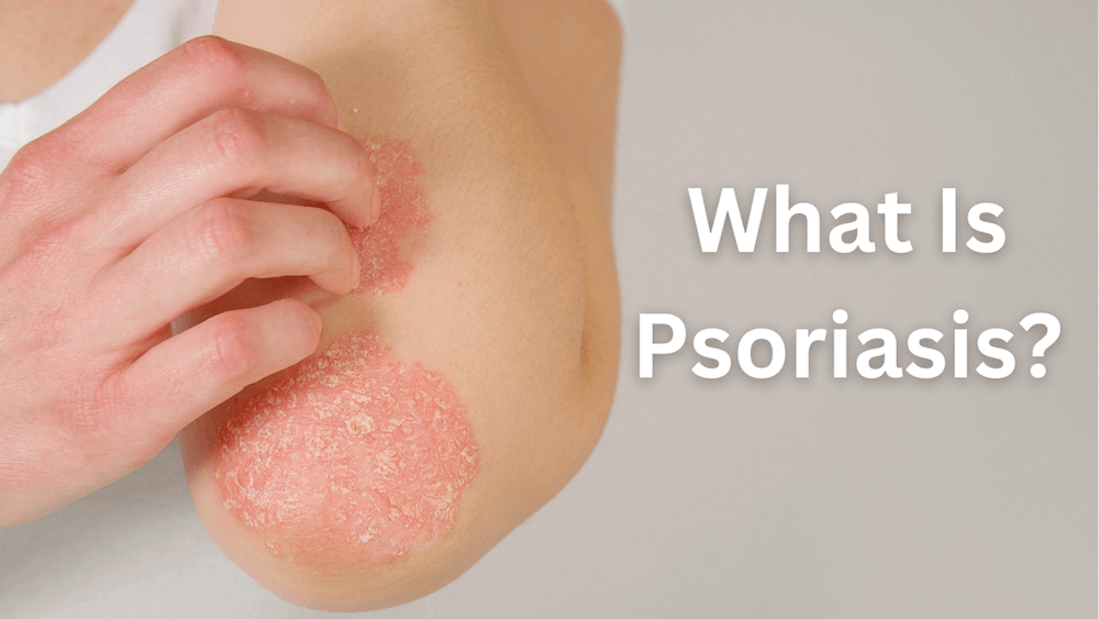 Vảy nến (Psoriasis): Cơ chế bệnh sinh, triệu chứng lâm sàng