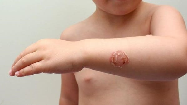 Bệnh chốc (Impetigo): Nguyên nhân, triệu chứng, chẩn đoán và điều trị