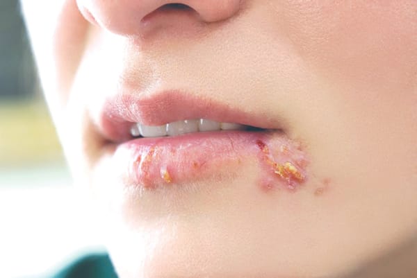 Bệnh Herpes: Những điều cần biết